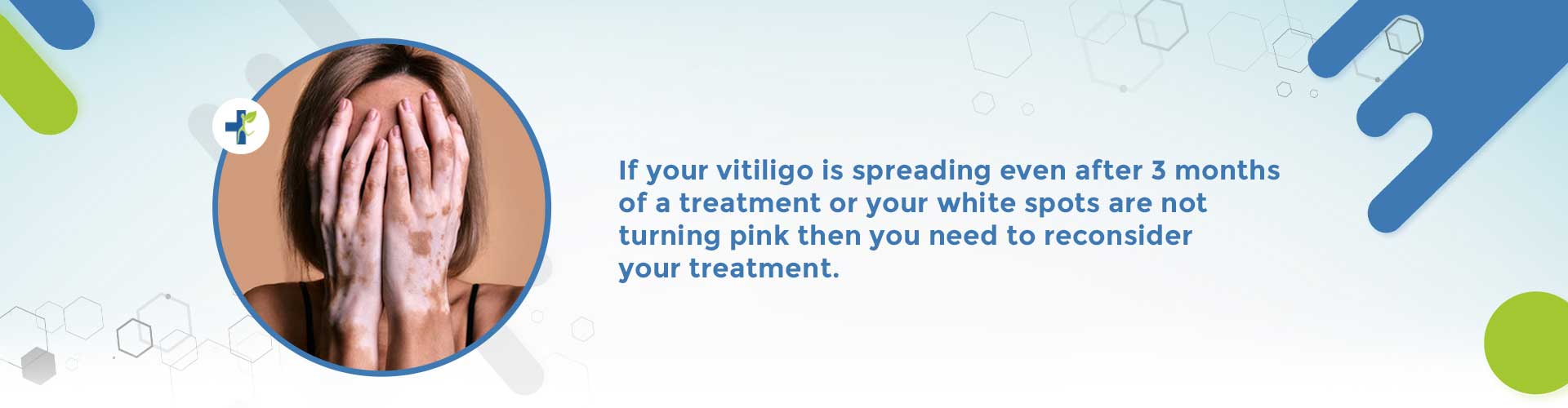 vitiligo