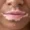 Vitiligo Patches on Lips