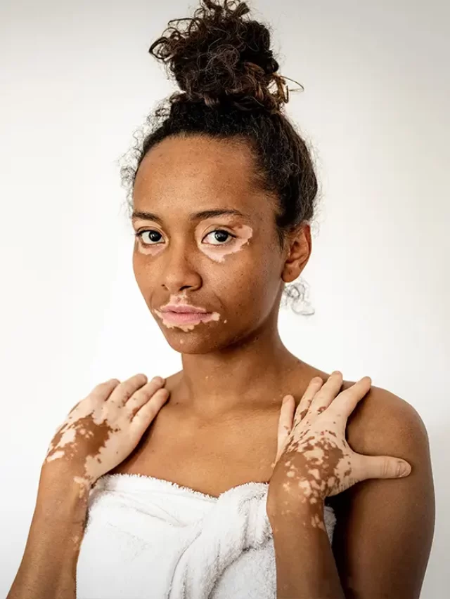 Cure Vitiligo at Home in just 30 Days