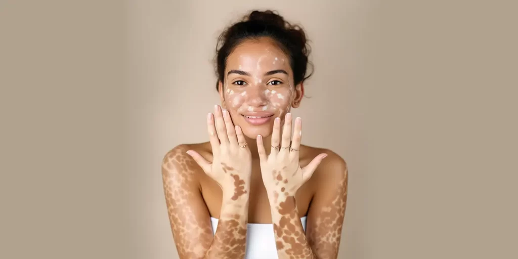 Vitiligo Ayurvedic Treatment