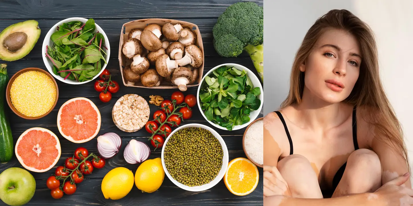 10 Foods to Eat in Vitiligo