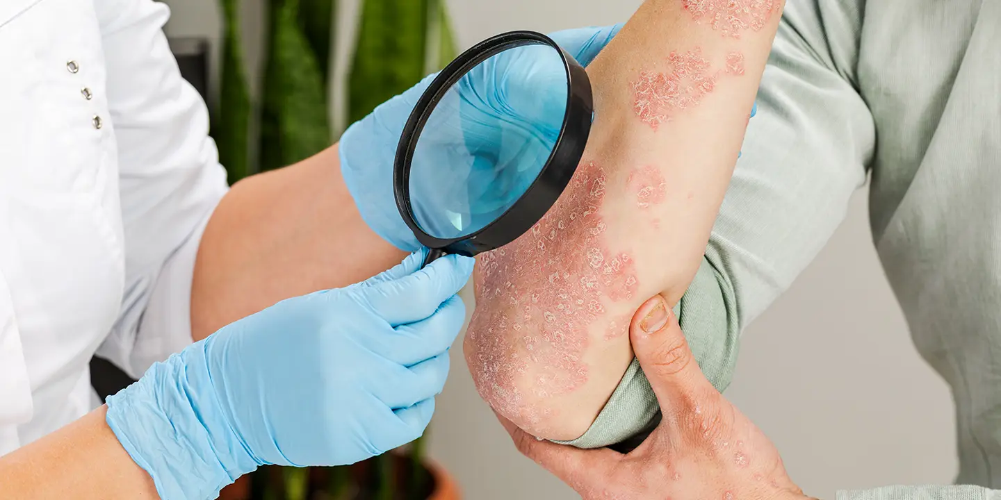 Psoriasis: What It Looks Like and How to Treat it | WS Dermatology