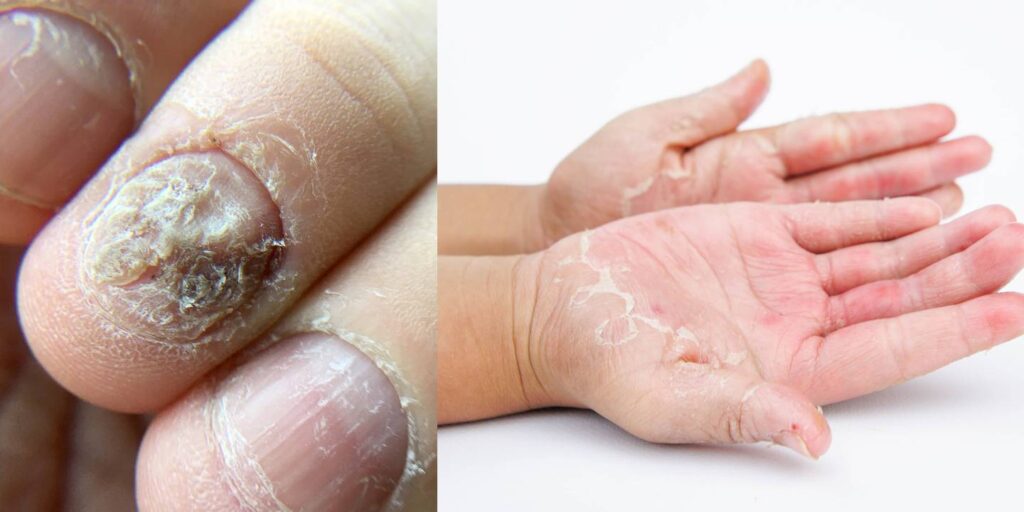 Are You Seeing Holes & Dents In Nails? Read This!