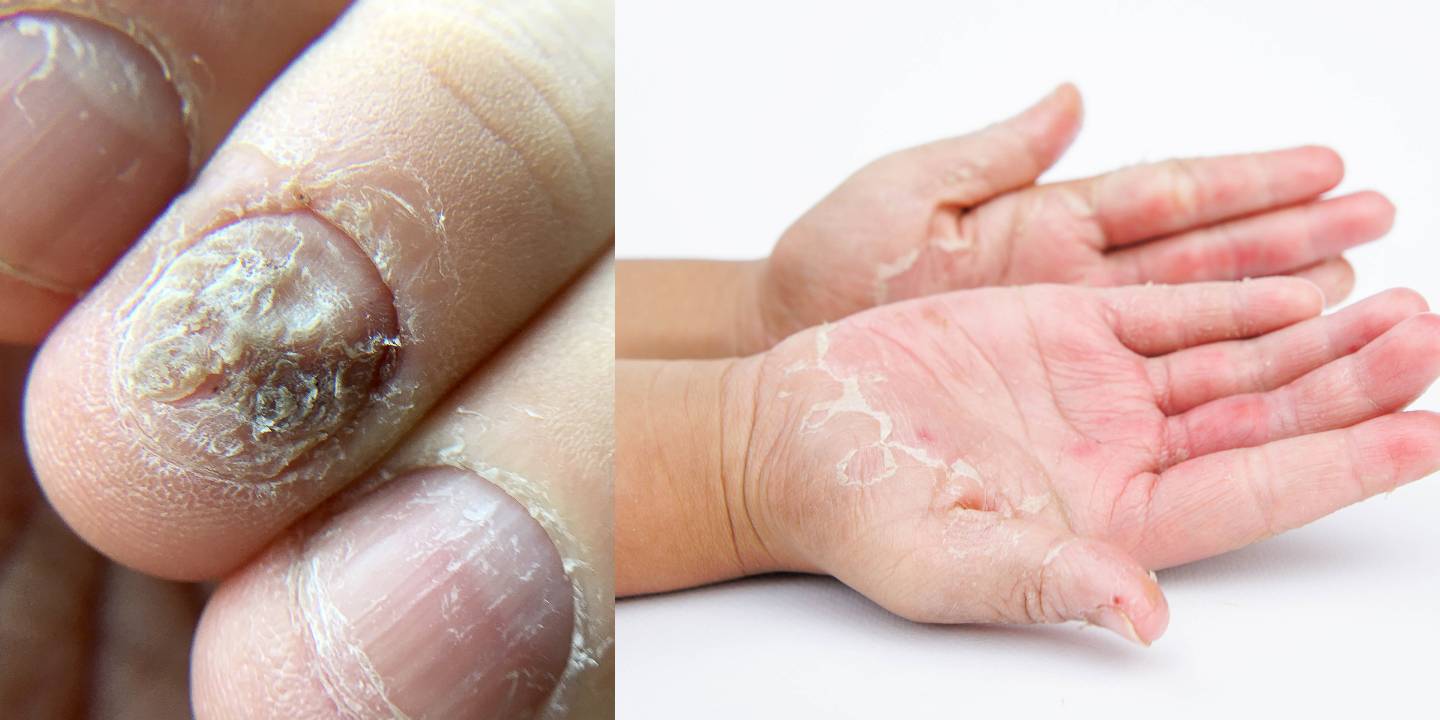 Chronic Paronychia: A Rundown Of The Fingernail Infection - Angeline Yong  Dermatology