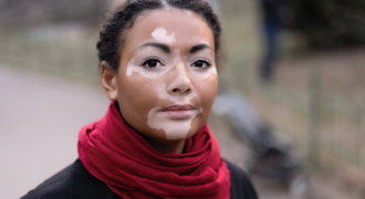 Why is Early Treatment Necessary for Vitiligo (सफेद दाग)