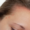 can-scalp-psoriasis-be-cured-permanently