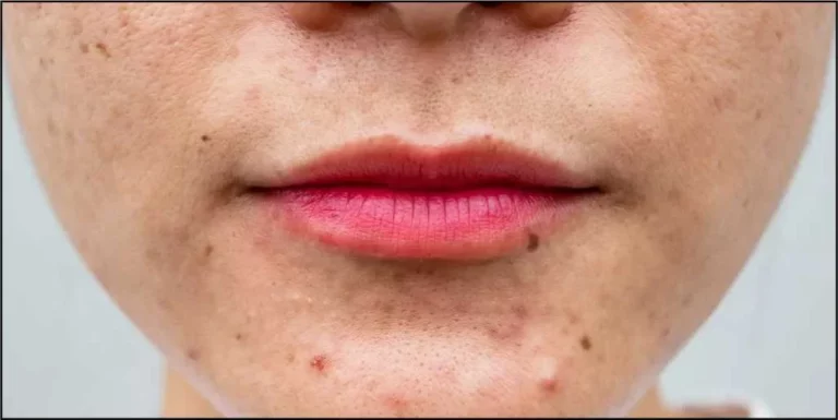 can b12 injections cause skin rash The Impact of Vitamin B12 Deficiency on Skin Health