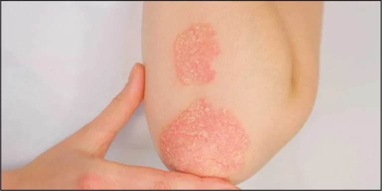 is-there-a-100-percent-cure-for-psoriasis