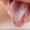 white-spot-on-tongue