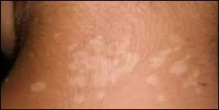 white-blotches-on-back-of-neck